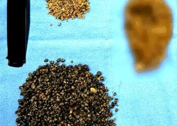 गुरुग्राम में मरीज के गॉल ब्लैडर से 8125 पथरी निकाली